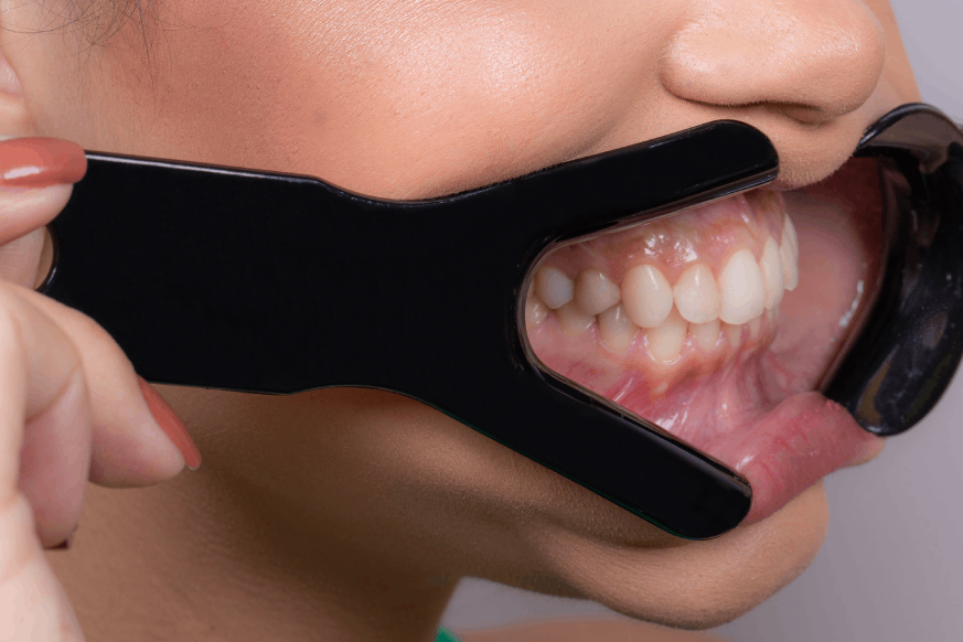 Cheek Retractors V-Shape - Image 4